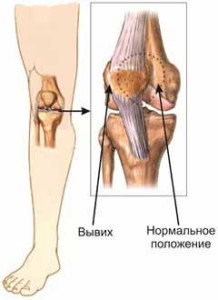 Вывих надколенника и ЛФК